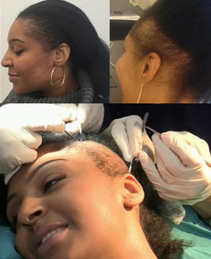 hair replacement